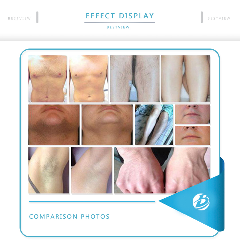 BESTVIEW-Professional medical beauty equipment specialist