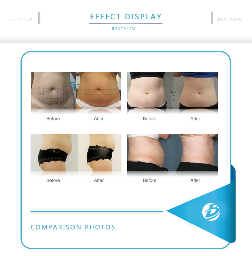 BESTVIEW-Professional medical beauty equipment specialist