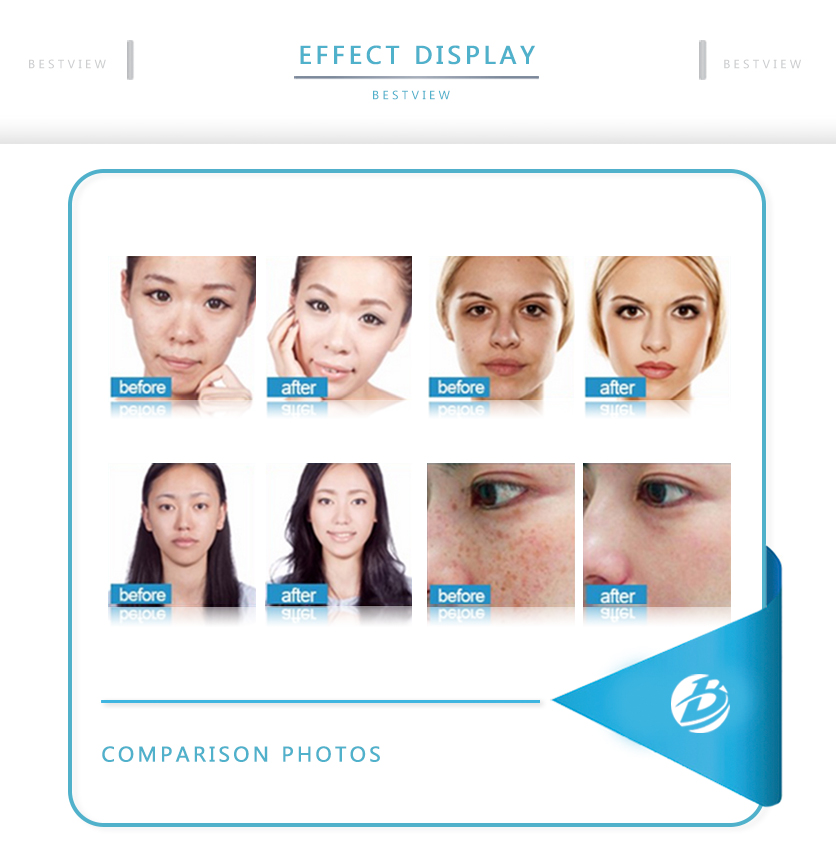 BESTVIEW-Professional medical beauty equipment specialist