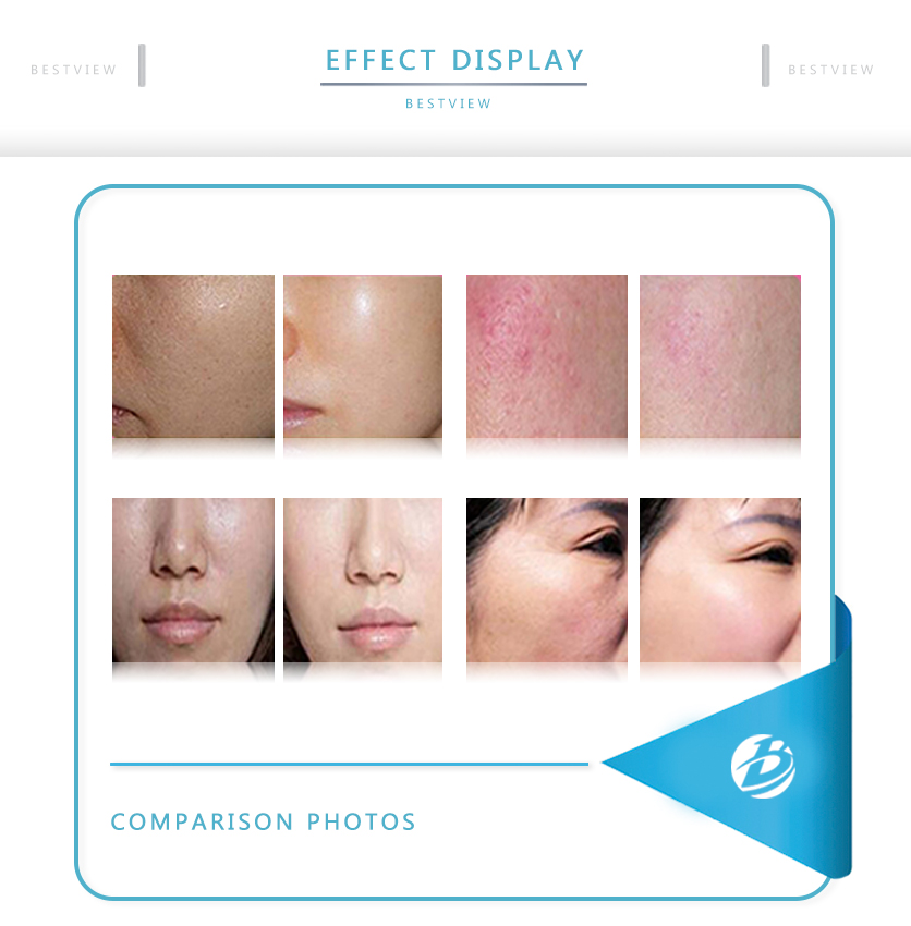 BESTVIEW-Professional medical beauty equipment specialist