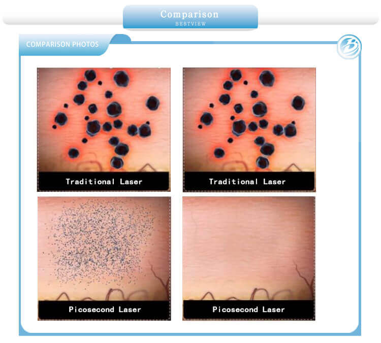  portable picosure tattoo removal machine