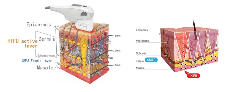 3D HIFU machine