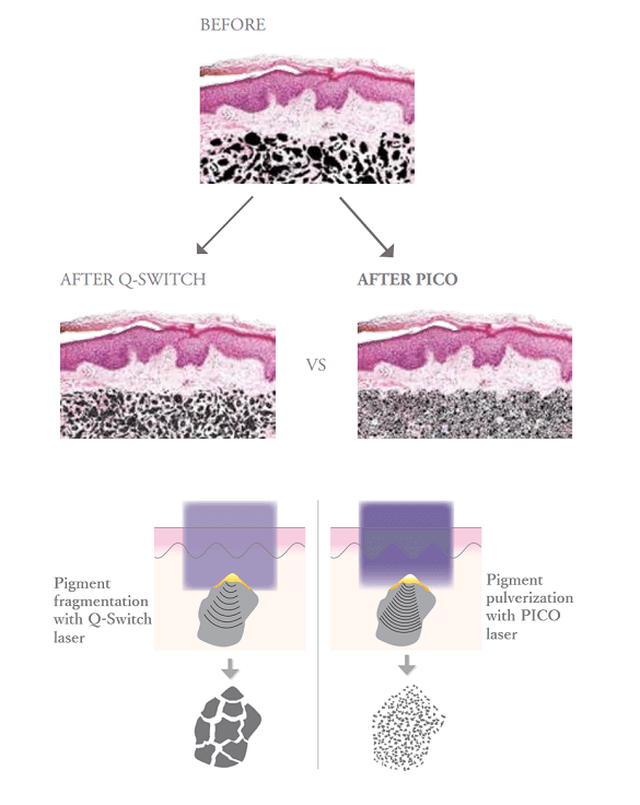 The Difference Between Q Switch Laser And Picosure Laser