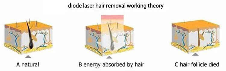 diode laser  hair removal machine