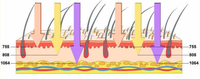 Do you really know the triple wavelength laser hair removal?