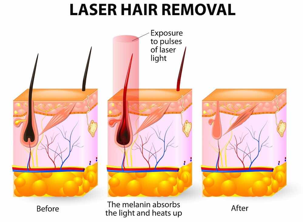 diode laser hair removal machine