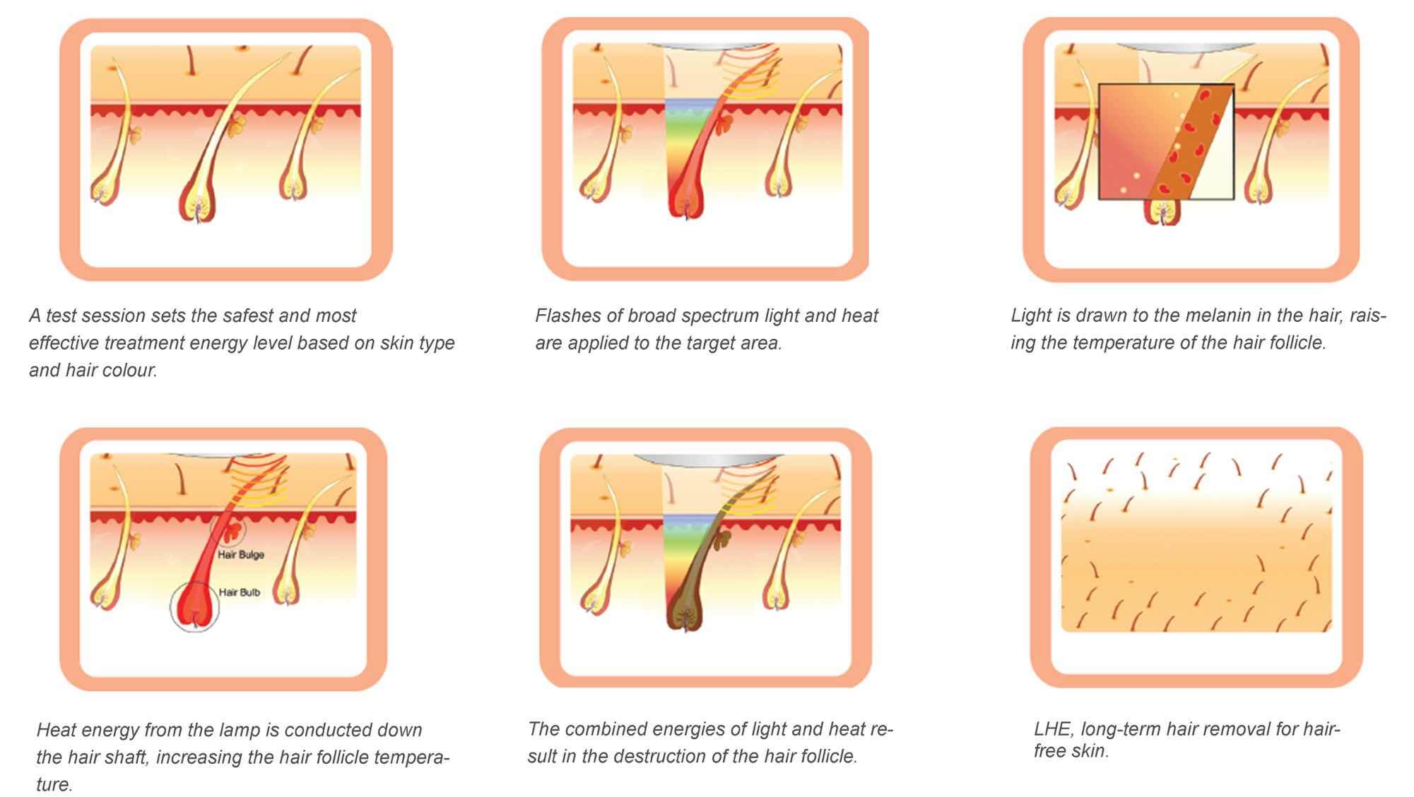 diode lasr hair removal machine