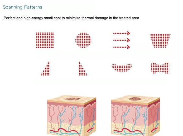 Fractional CO2 laser scar removal - Zhengzhou, Henan, China