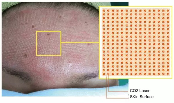 co2 laser acne scars