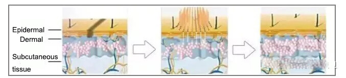 co2 laser acne scars 3