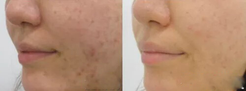 co2 laser acne scars