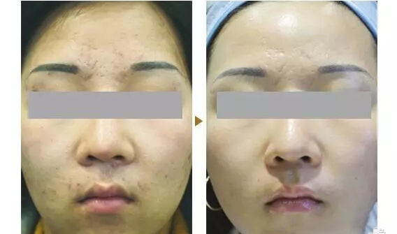 co2 laser acne scars