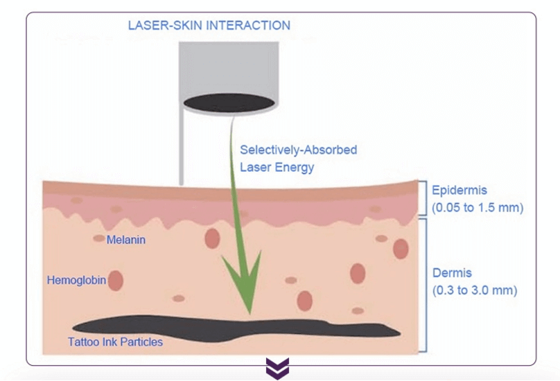 laser tattoo removal machines