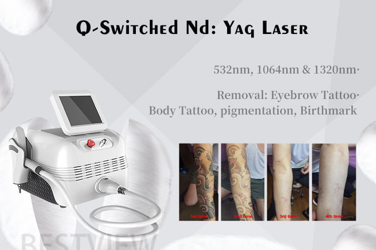 q switched nd yag laser tattoo removal machine