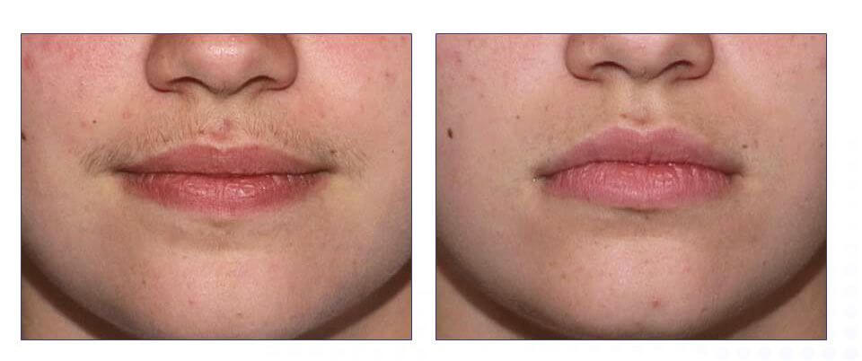 Permanent Facial Hair Removal