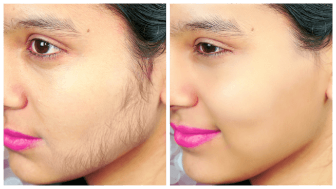 Permanent Facial Hair Removal 