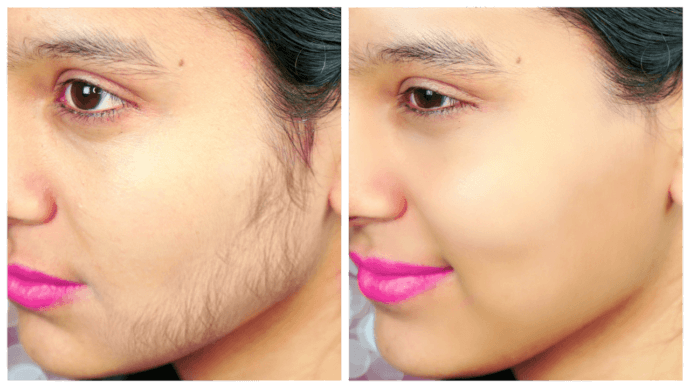Permanent Facial Hair Removal