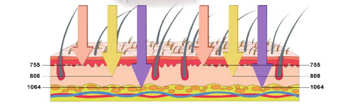 laser hair removal