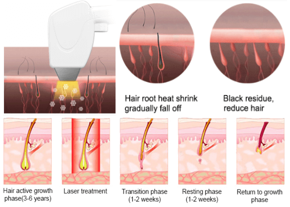 1200W Diode Laser Hair Removal Machine