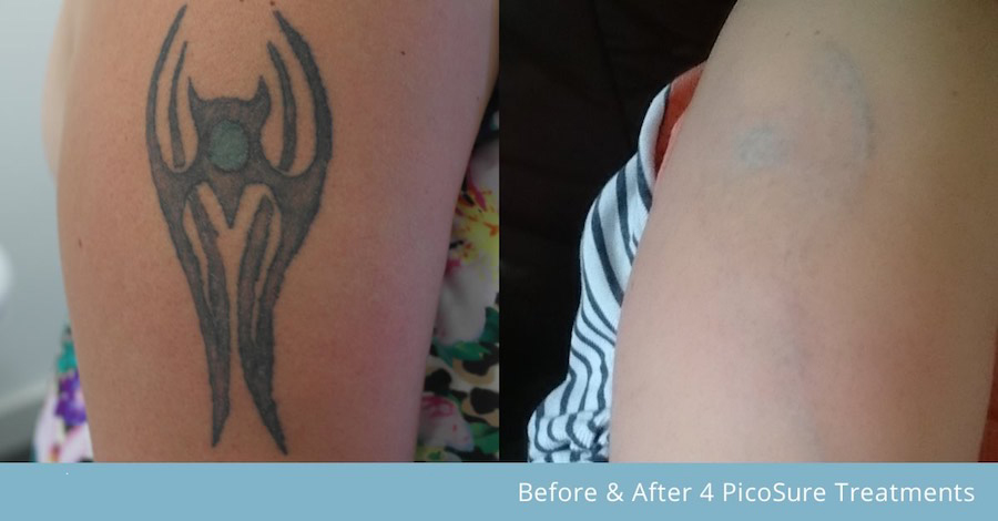 portable laser tattoo removal machine