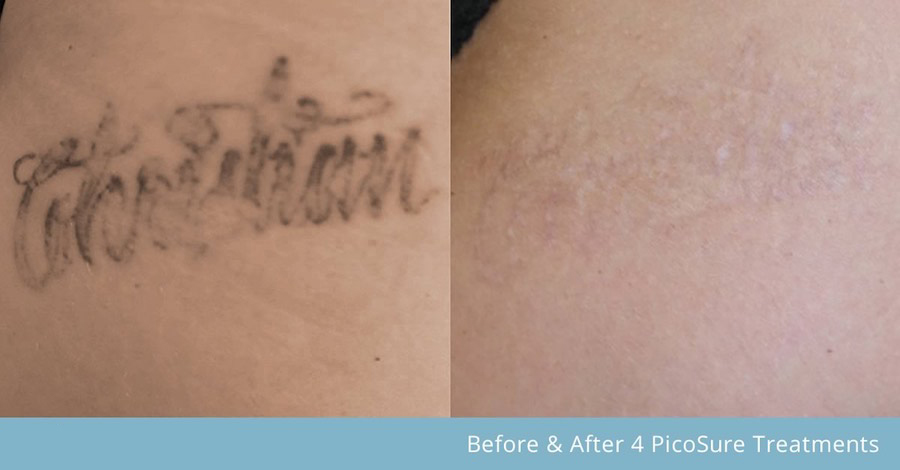 portable laser tattoo removal machine