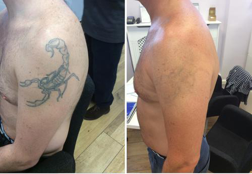 picosure laser tattoo removal 