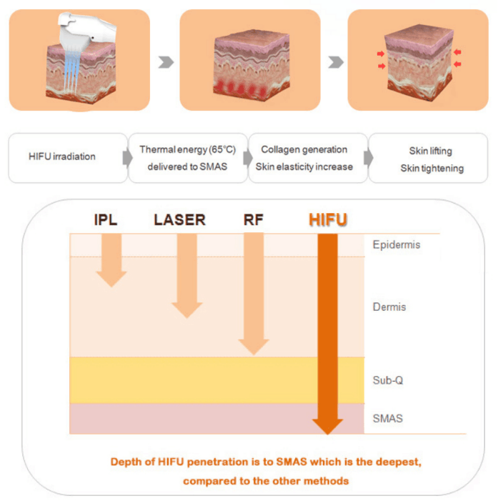 4D HIFU skin rejuvenation machine