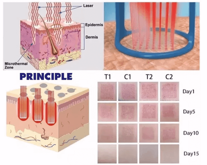 fractional laser machine