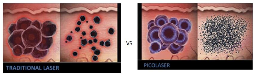 picosure laser machine