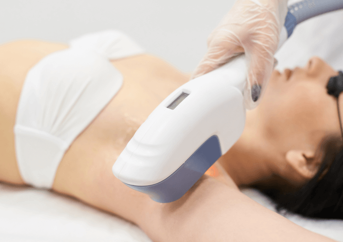 opt laser hair removal