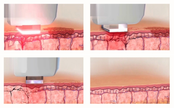 opt ipl laser