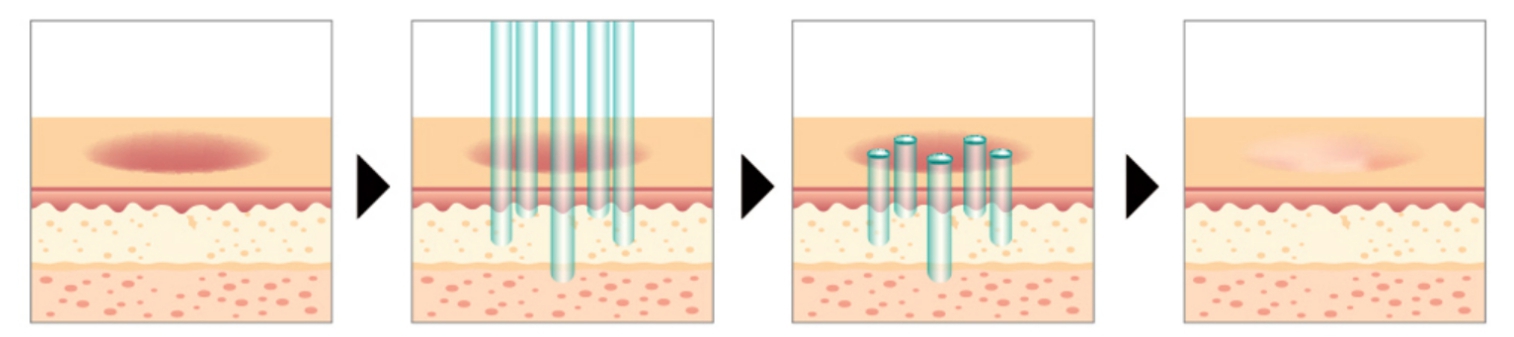 CO2 fractional laser