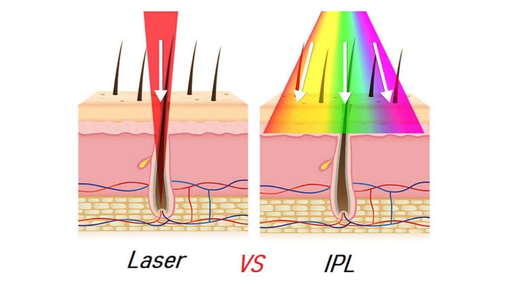 IPL vs laser