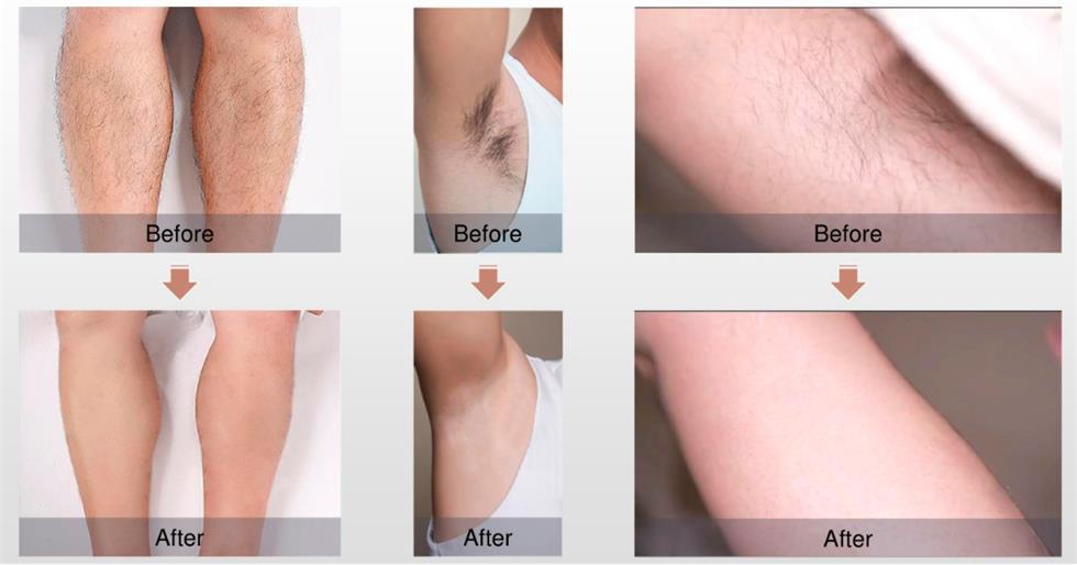 hair removal before and after