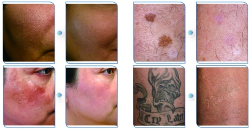 tattoo Removal Laser 