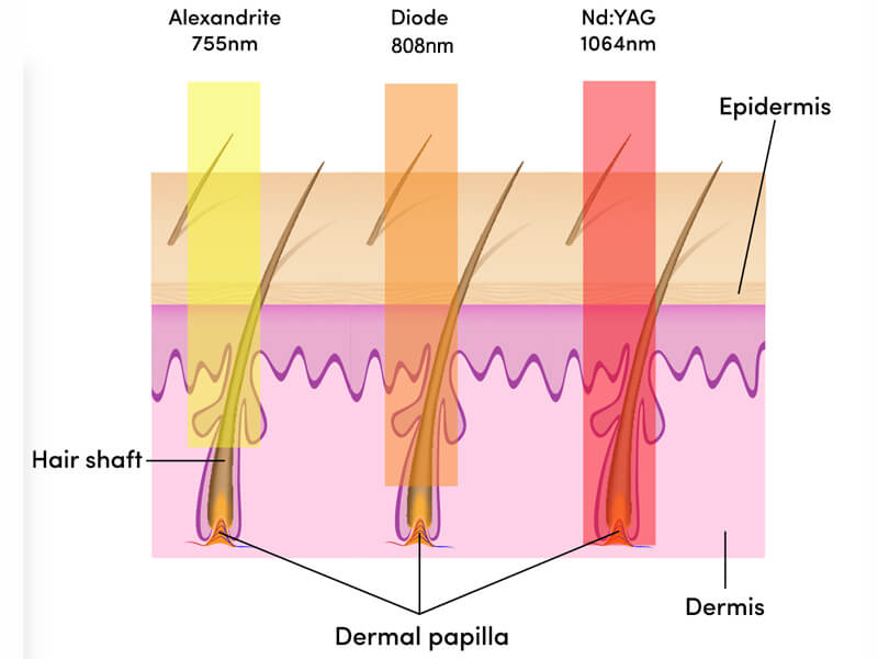 diode laser hair removal machine