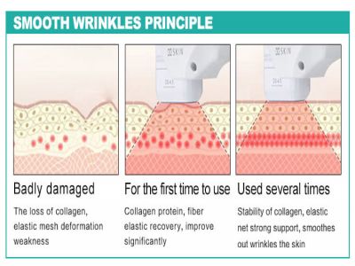 The Advantages You Should Know About Our 4D HIFU Machine