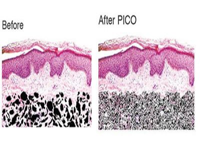 Picosecond Freckle Removal And Ordinary Laser Freckle Removal Difference