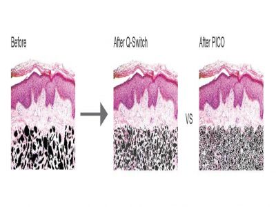 The Difference Between Q Switch Laser And Picosure Laser