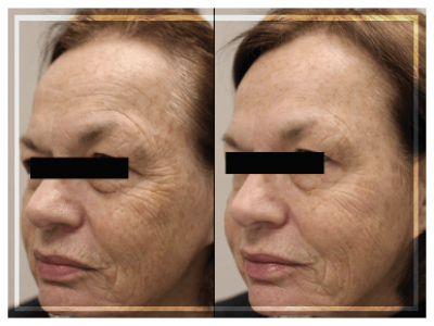 The Picosure Laser Machine Wrinkle Removal Treatment Tips