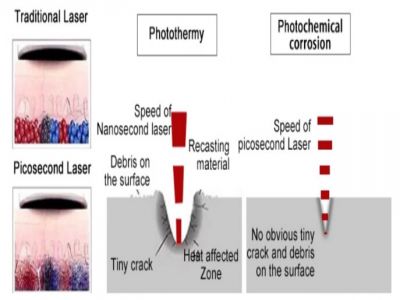 Tips You Should Know About The Picosure Laser