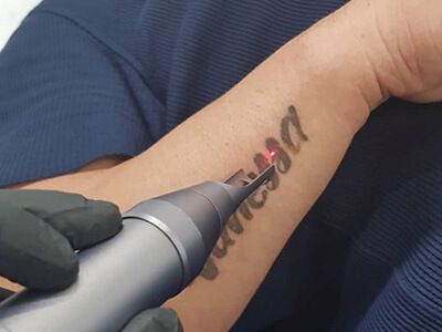 What Laser Tattoo Removal Machine We Have For Your Tattoo Shop?