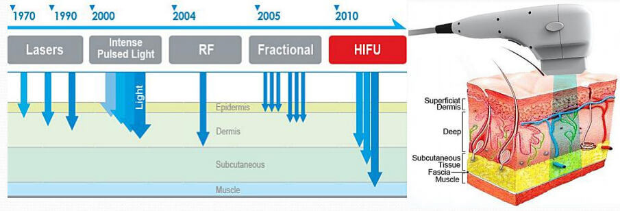 hifu machine working theory