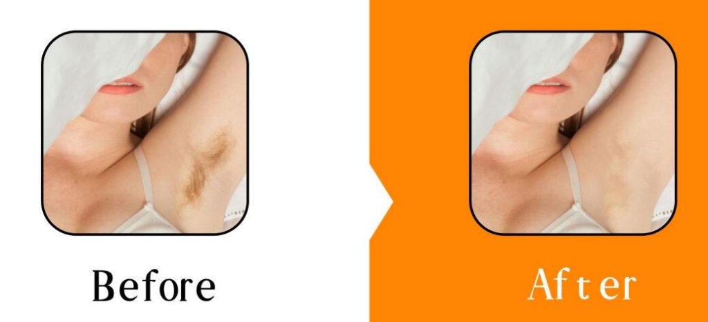 diode laser hair removal machine before and after