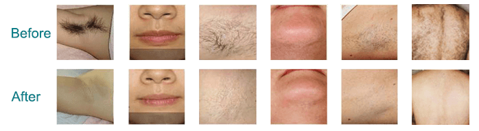 diode laser hair removal