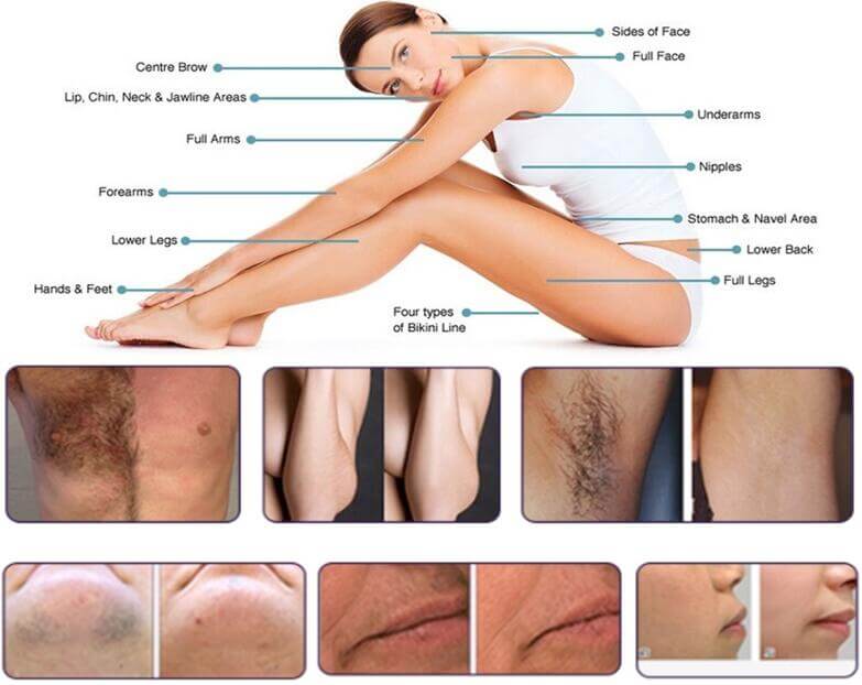 best diode laser hair removal machine