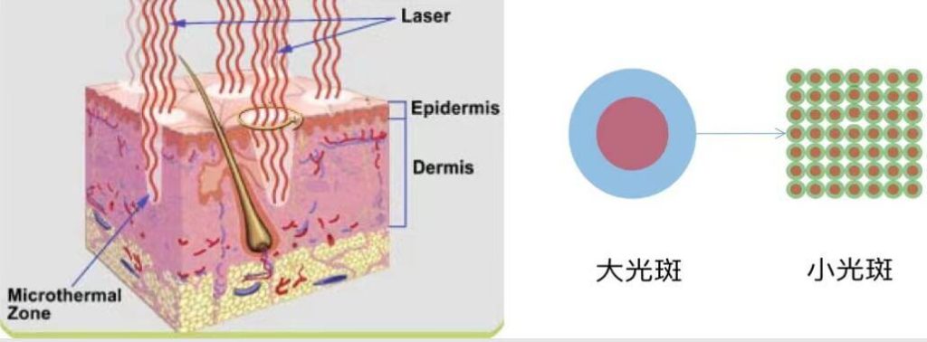 co2 fractional laser