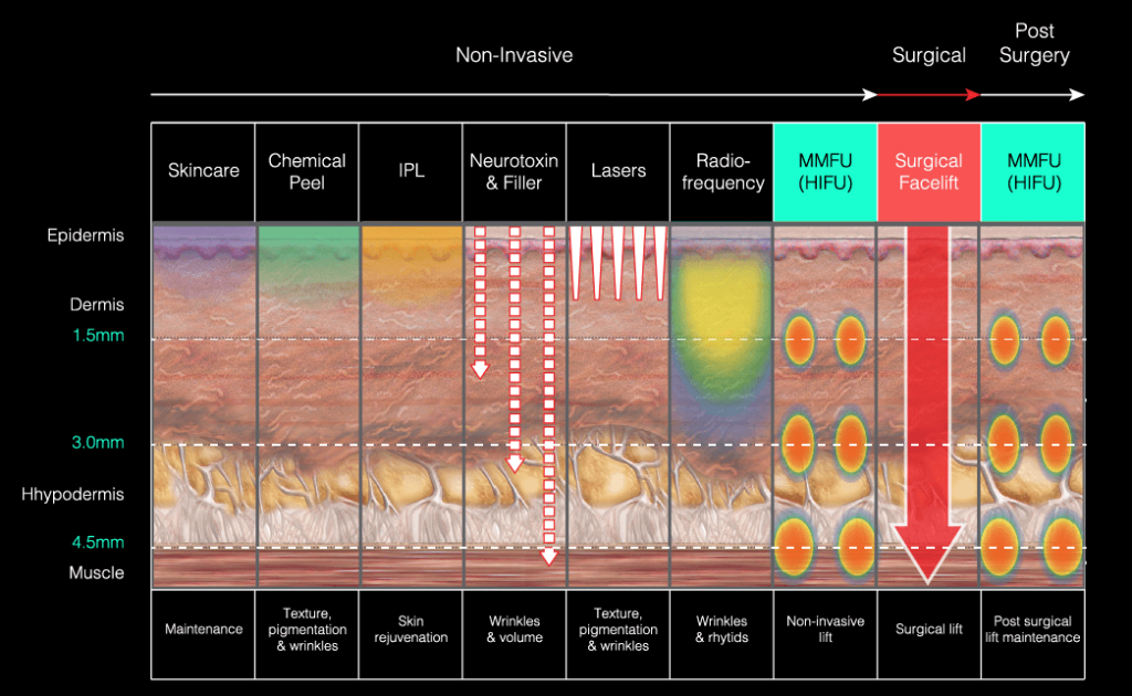 4d hifu treatment