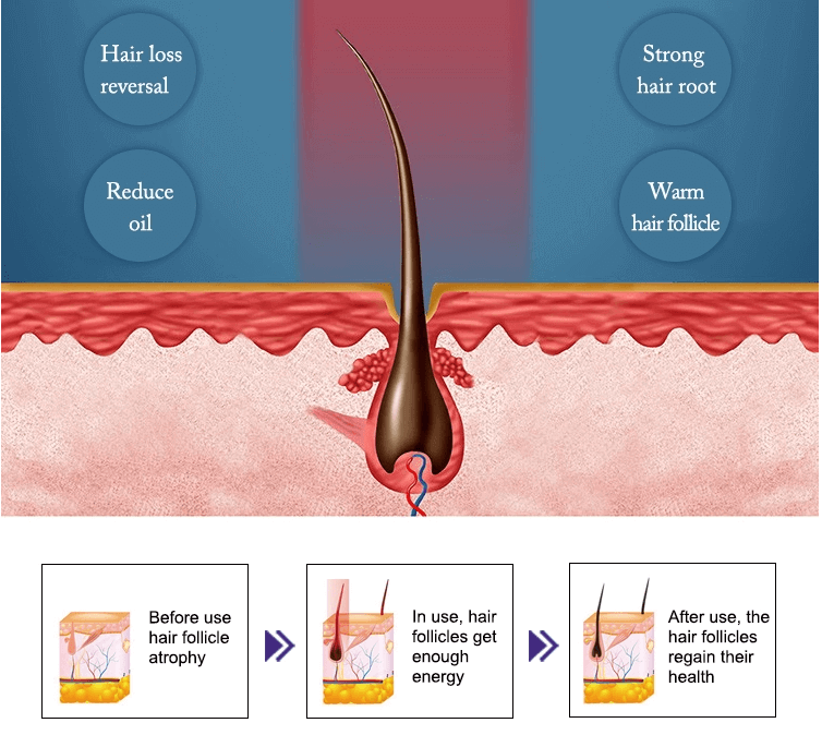 diode laser hair regrowth machine