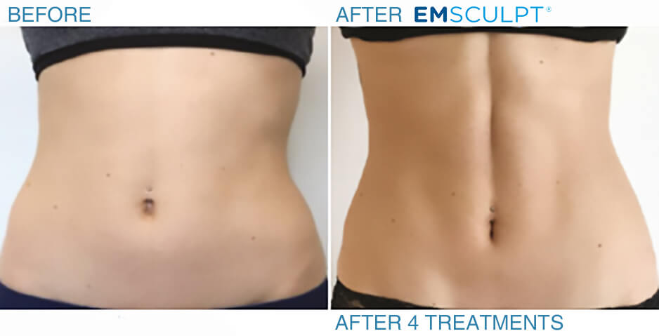 emsculpt before and after 1 treatment